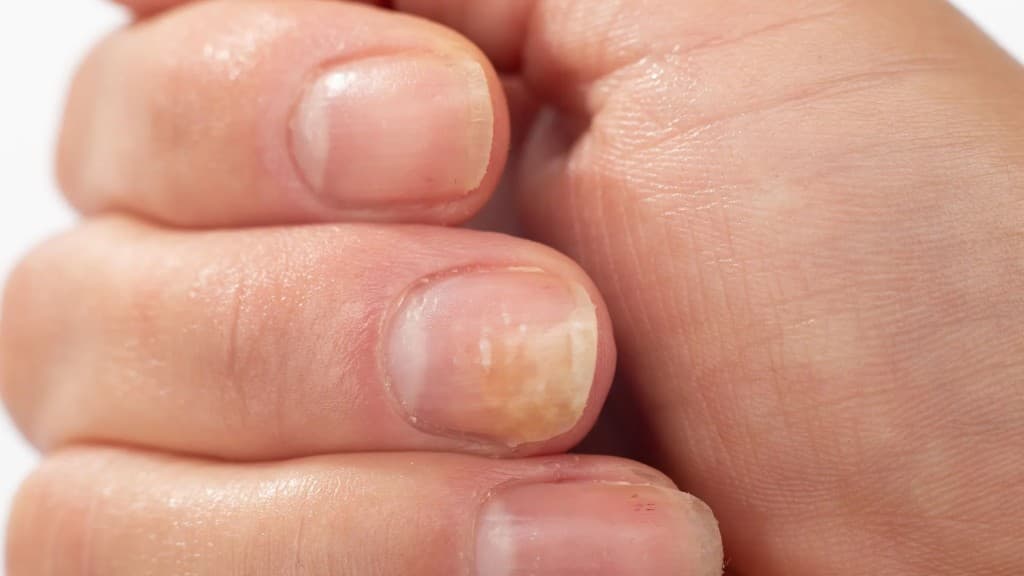 Pathologies unguéales